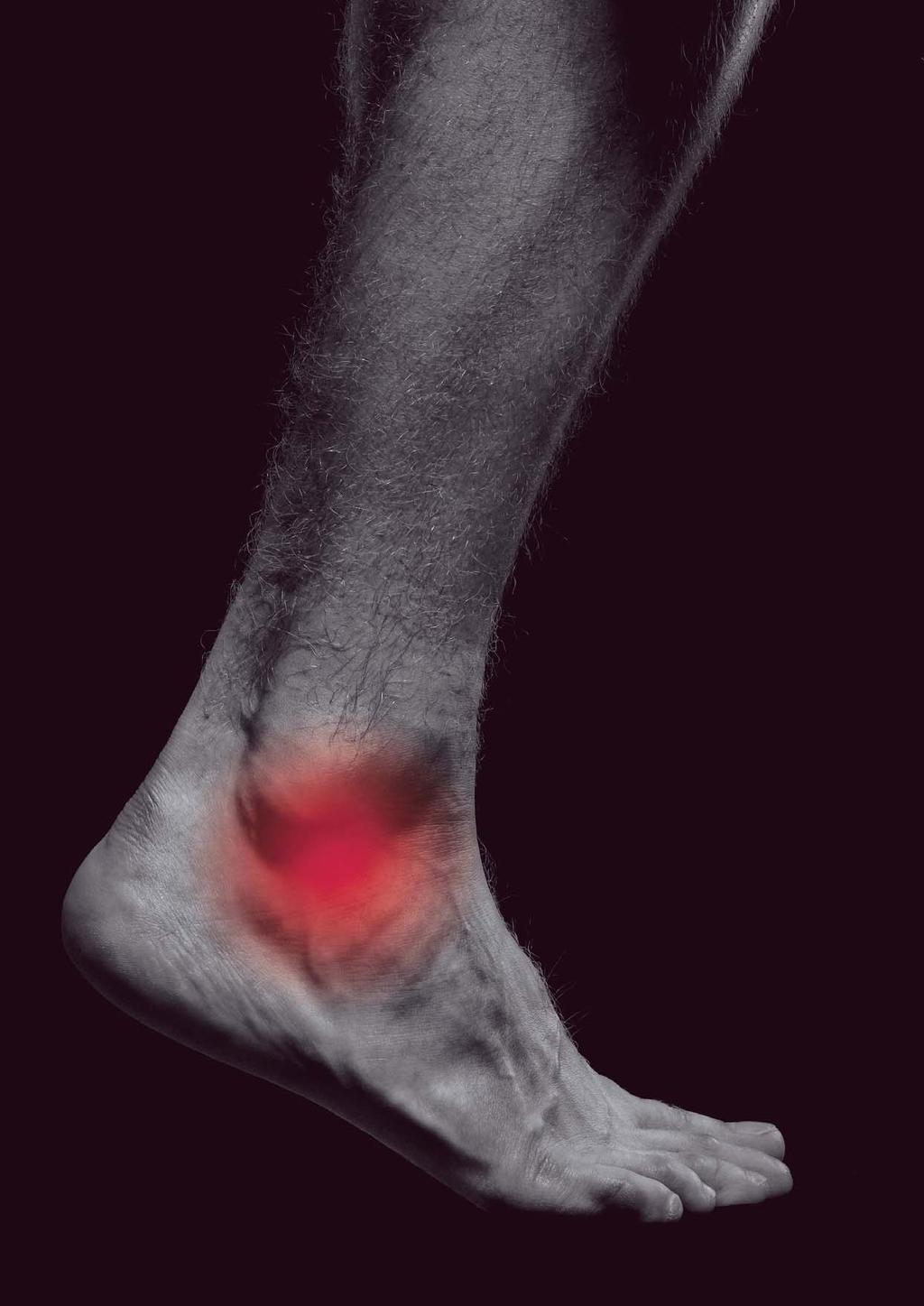 THE ANKLE IS ONE OF THE MOST INJURIED JOINTS IN THE BODY. Even a light sprain can prove to be complicated and lead to instability. A correct acute treatment is essencial for a fast rehabilitation.