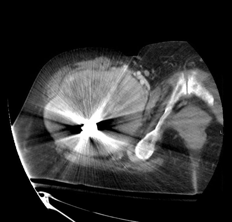 Radiological Presentations There is a large 12 x 13 x 20 cm (AP by transverse by craniocaudal) heterogeneously enhancing, hypervascular mass surrounding the right femoral prosthesis involving the