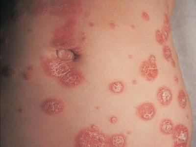 1 Psoriasis What is Psoriasis? Psoriasis is a long standing inflammatory non-contagious skin disease which waxes and wanes with triggering factors. There is a genetic predisposition in psoriasis.