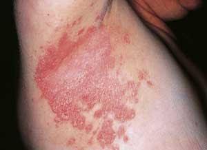 4 2. Flexural psoriasis: well defined skin patches on skin folds like armpit areas, groin area, infra-mammary areas,