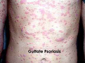 Intra-oral psoriasis: there will be blistering and ulcers in the mouth. 5.