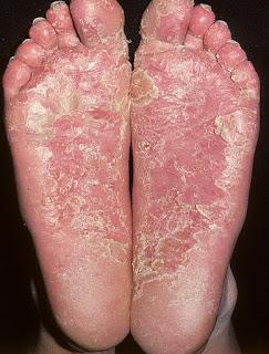 6 8. Palmoplantar psoriasis: skin lesions mainly