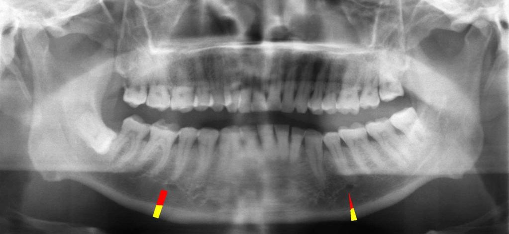 Fig. 1 Panoramic radiograph of a 55-year-old man. MCW (yellow) was 4.5 mm on the right side and 4.2 mm on the left side.