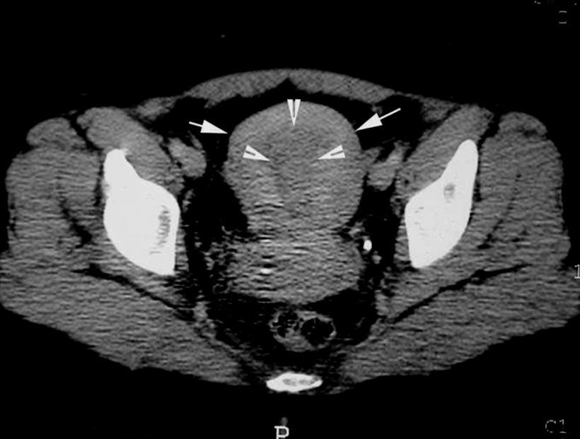 CT and MRI scanning may be required for the diagnosis and assessment of perforated pyometra.