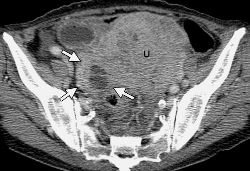 (a) Axial contrast-enhanced CT image shows a mixed solid and