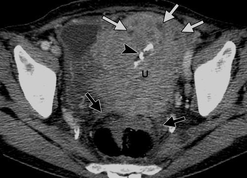 (b) Axial contrast-enhanced CT image obtained at a lower level
