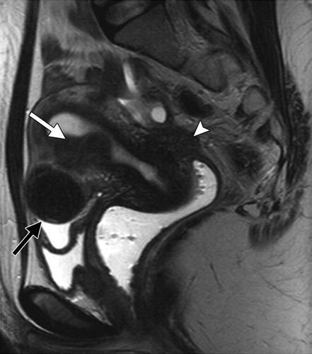 vesicovaginal septum (outlined in yellow) Endometriotic involvement of the posterior pelvic compartment in a 29-year-old woman with