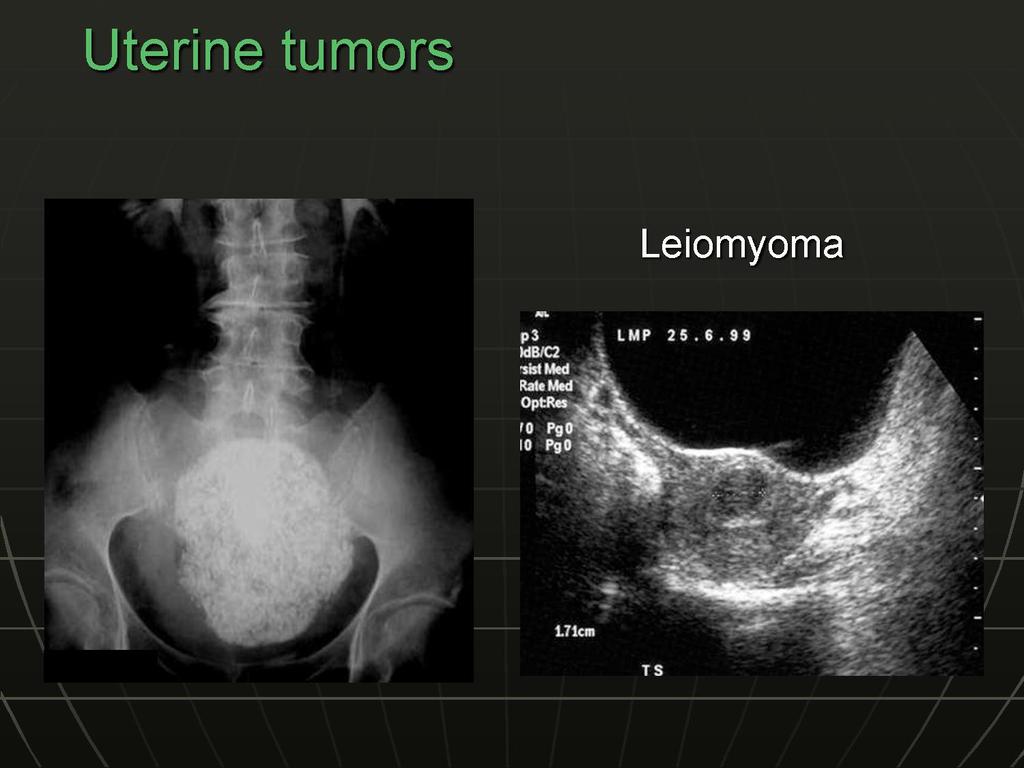 LEIOMYOMA=is a benign smooth muscle
