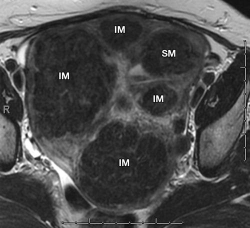 Multiple intramural leiomyomas in a 50-year-old