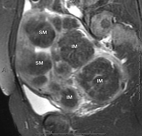 Axial (a) and sagittal (b) T2-weighted images