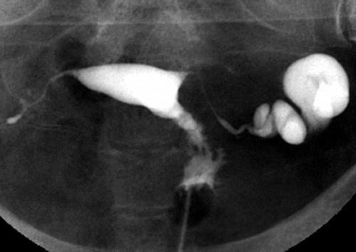 Radiography shows dilatation of the ampullary portion of the left fallopian tube, a finding that is consistent with a