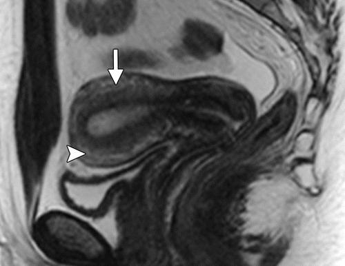 thickness Normal uterine zonal anatomy. Sagittal image shows the normal uterine zonal anatomy.
