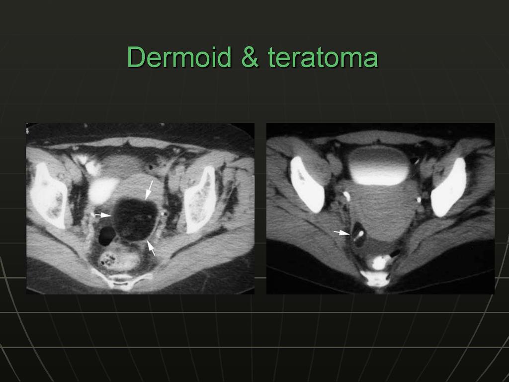 The diagnosis of teratoma or dermoid at CT and MR imaging is fairly
