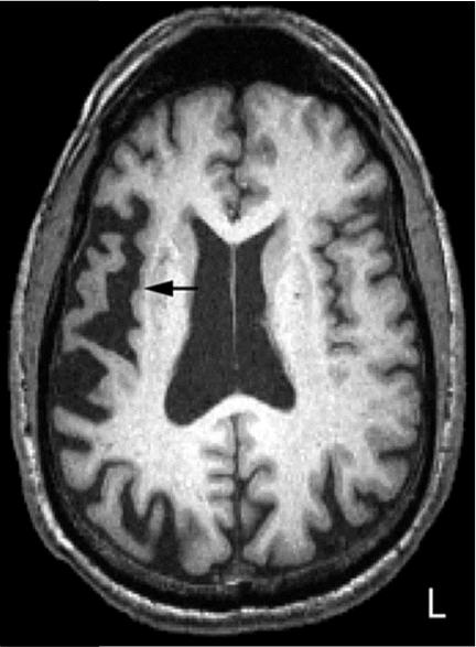 aphasia (PPA) Rascovsky K et al. Brain.