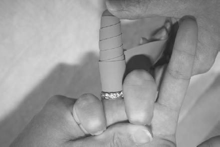 Begin to unwrap the string from the proximal end (Figure 10.3), which will begin to move the ring off the finger FIGURE 10.