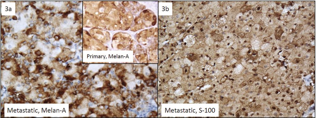 Figure 3: Metastatic balloon cell malignant melanoma (BCMM). (a) Metastatic BCMM, positive for Melan-A (Melan-A, 40x).