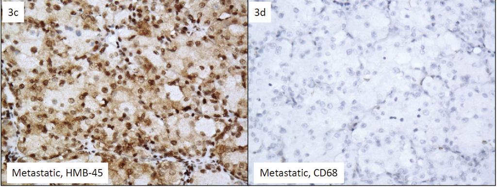 Transitional cells show darker cytoplasmic staining than balloon melanoma cells (Melan-A, 40x); (b) Metastatic BCMM, positive for S-100.