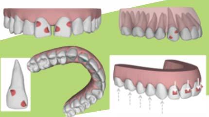EVOLUTION OF INVISALIGN Significant increase in applicability Tremendous predictability improvements From a toolbox to solutions Single