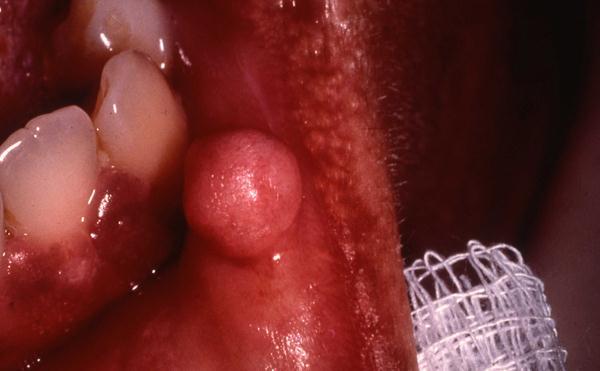 2014 course two GINGIVAL PATHOLOGY The primary focus of this study centers on abnormal proliferations and disease processes that can involve the gingiva, either exclusively or as a part of their