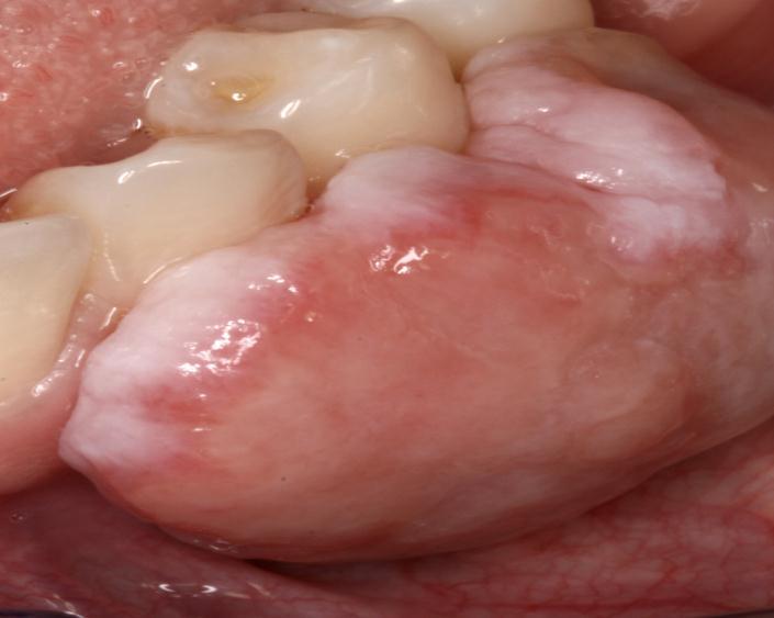 PERIPHERAL OSSIFYING FIBROMA: Peripheral ossifying fibroma is a common, reactive proliferation of fibroblasts that occurs exclusively on the gingiva.