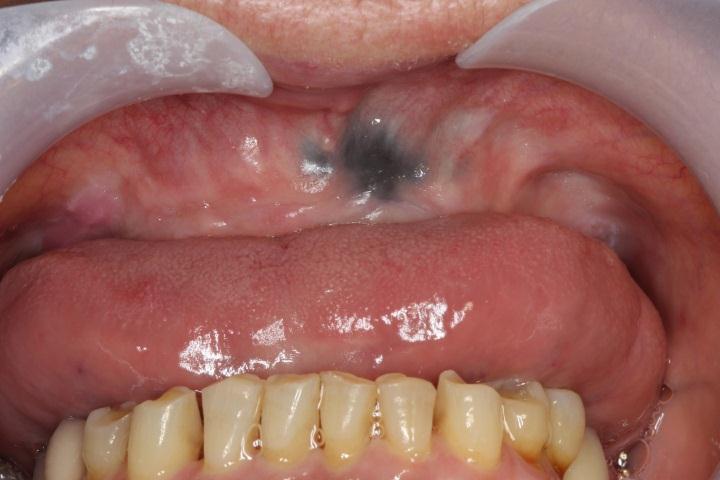 commonly involving the gingiva. Usually an amalgam restoration can be identified in the vicinity of the lesion.