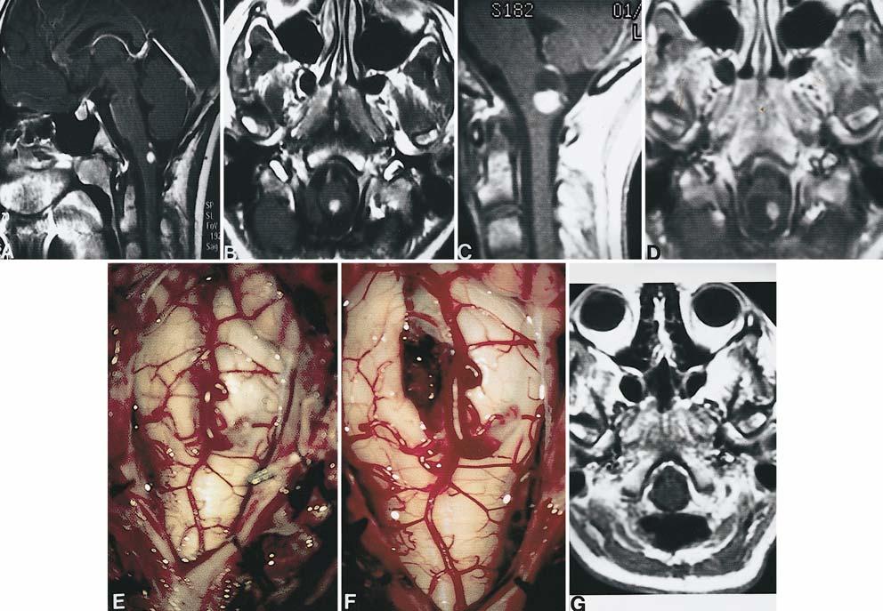 R. J. Weil, et al. FIG. 1. Case 12. A and B: Contrast-enhanced sagittal (A) and axial (B) MR images of the brain obtained 6 months before surgery, revealing a small hemangioblastoma and no cyst.