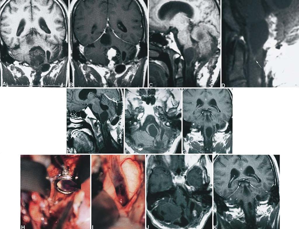 Surgery of brainstem hemangioblastomas FIG. 3. Case 6. A and B: Coronal MR images obtained before (A) and after (B) addition of contrast material, revealing a large hemangioblastoma and cyst.