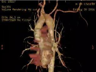 CECT Venous Phase Coronal MIP Image Showing Double SVC- Both are Draining to