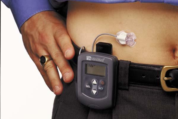 Continuous Glucose Monitoring