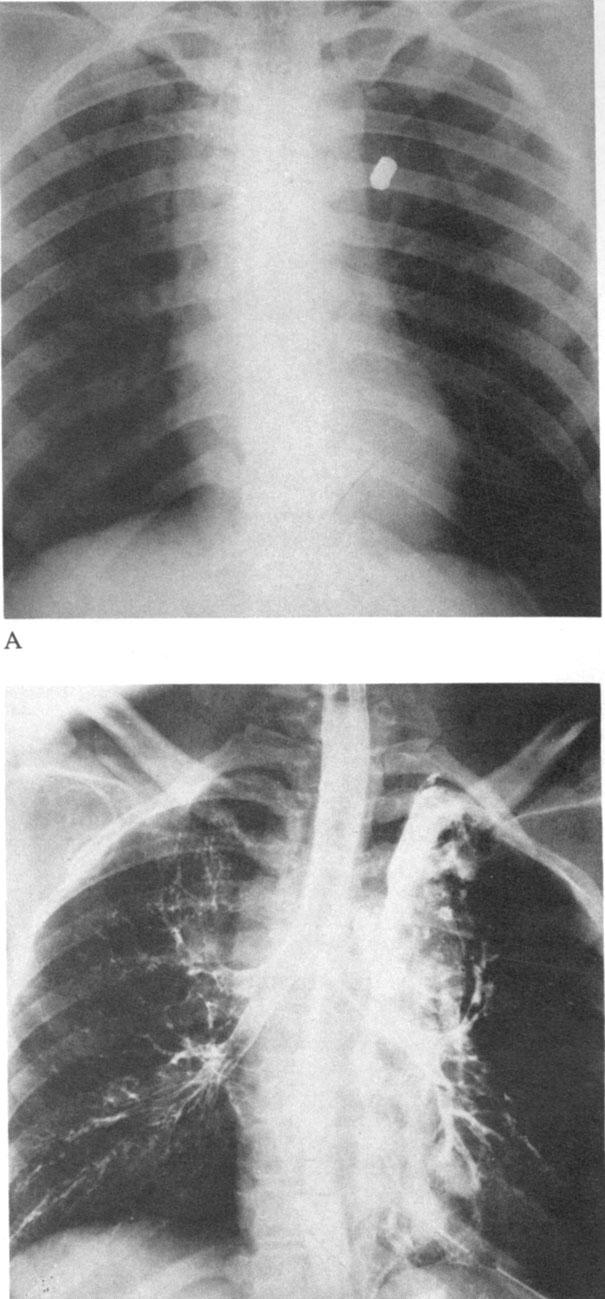 475 Symbas, Hatcher, and Boehm: Acute Penetrating Tracheal Trauma jured vessels were ligated.