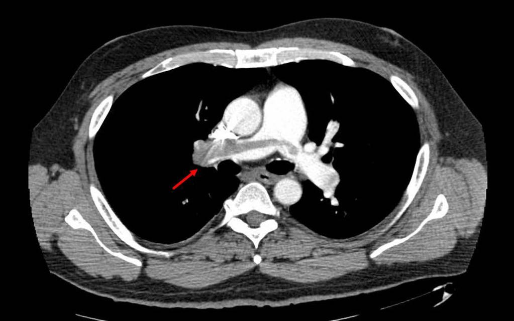 PE, pulmonary embolism Vascular Medicine. www.