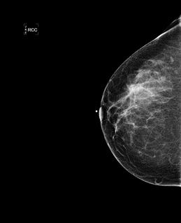 Imaging Bilateral mammogram: Left breast spiculated mass measuring 5 cm with left axillary dense nodes Ultrasound: Left breast mass at 3:30