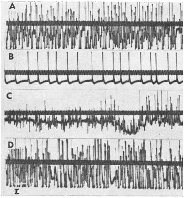 The electromyogrphicl Fro. 2. Fourth lumbr disc hernition (Cse 85). The only clinicl sign ws extreme trophy of M. extensor digitorum brevis. (A) Affected foot. (B) Norml foot for comprison. FIG. 3.