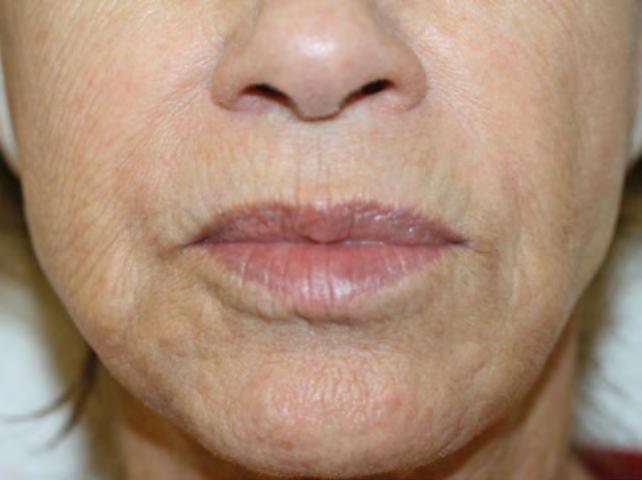 Figure 4. 69-year-old woman before () and 6 years after treatment of the perioral area with roadand Light therapy at least once per year ().
