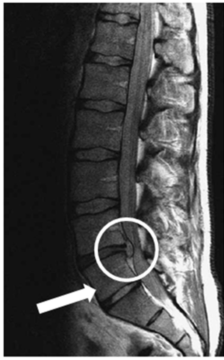 Fig. 0: The disc herniation above the LSTV (O'Driscoll type 3). Bron JL, et al.