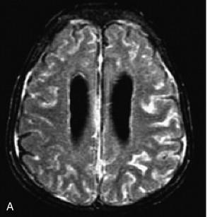 (bilateral papilledema) in MWS patient 3 Leptomeningeal enhancement and ventriculomegaly on MRI in CINCA patient 4 1. Goldbach-Mansky R.