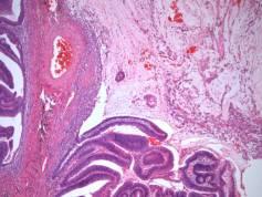 epithelial misplacement