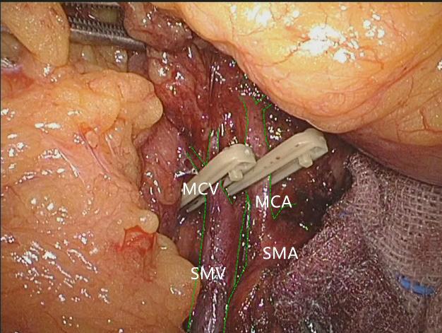 Appendix Laparoscope-assisted extended right hemicolectomy with D3 lymphadenectomy Extended D3 resection is needed for right colon resection in transverse colon