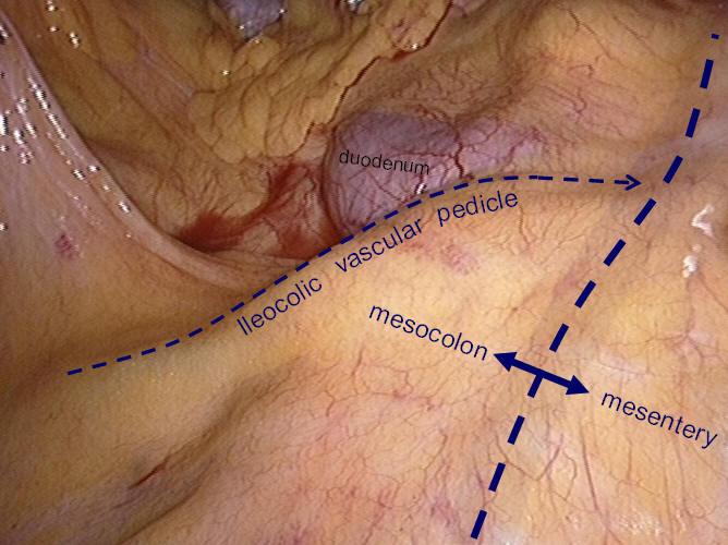 Ileocolic vessels Middle colon vessels metastases, and frozen pathology can be employed to diagnose liver metastases. Finally, the primary lesion is explored.