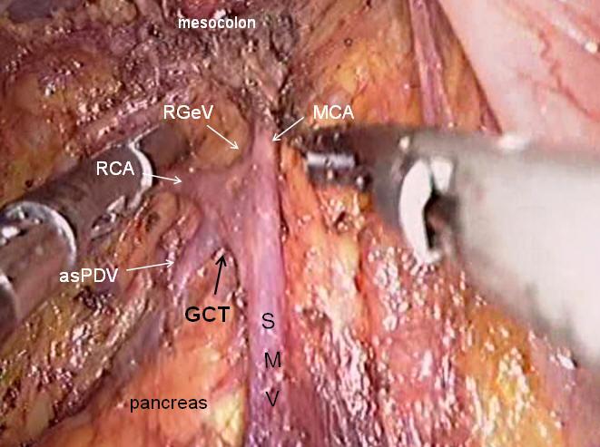 Page 6 of 10 Li. Laparoscopic extended right hemicolectomy with D3 lymphadenectomy Figure 14 Dividing of SMV.