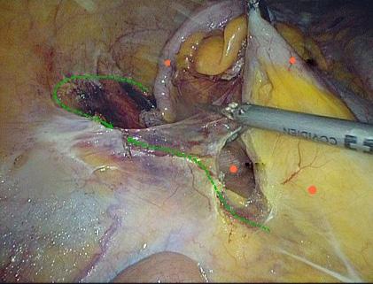 Under direct vision, transect the transverse colon, and ensure that the bowel resection margin is >10 cm from the edge of the lesion, including all dissected D3 lymph nodes.