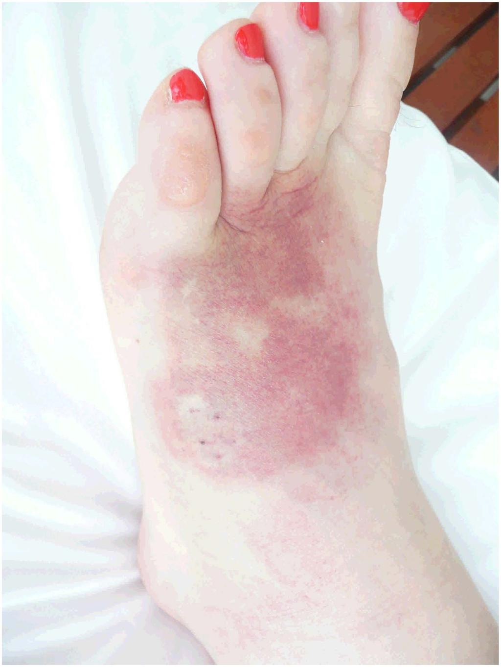 Figure 2. Local effects from a death adder bite to the foot. doi:10.1371/journal.pntd.0001841.