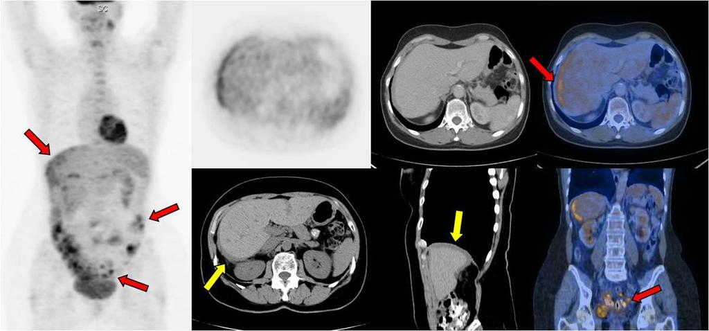 CT and normal CA-125 values. PET/CT shows increase F-18 FDG uptake in multiple peritoneal implants and retroperitoneal adenopathies (red arrows), without ascites. Fig. 3: Female (45 y).