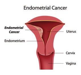 In female patients, endometrial cancer is particularly linked to Lynch syndrome.