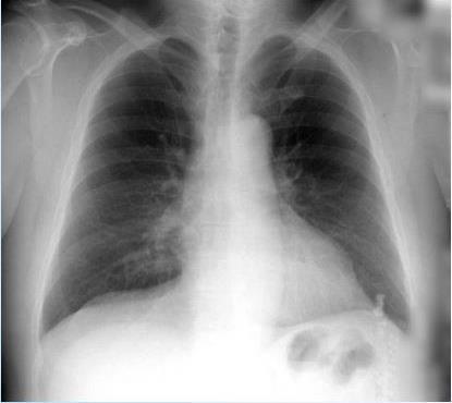 Pulmonary Fungal Infections: High Incidence and Impact Disease Pathophysiology Healthy Diseased Description Disease Overview Key contributor to morbidity and mortality in infected patients A