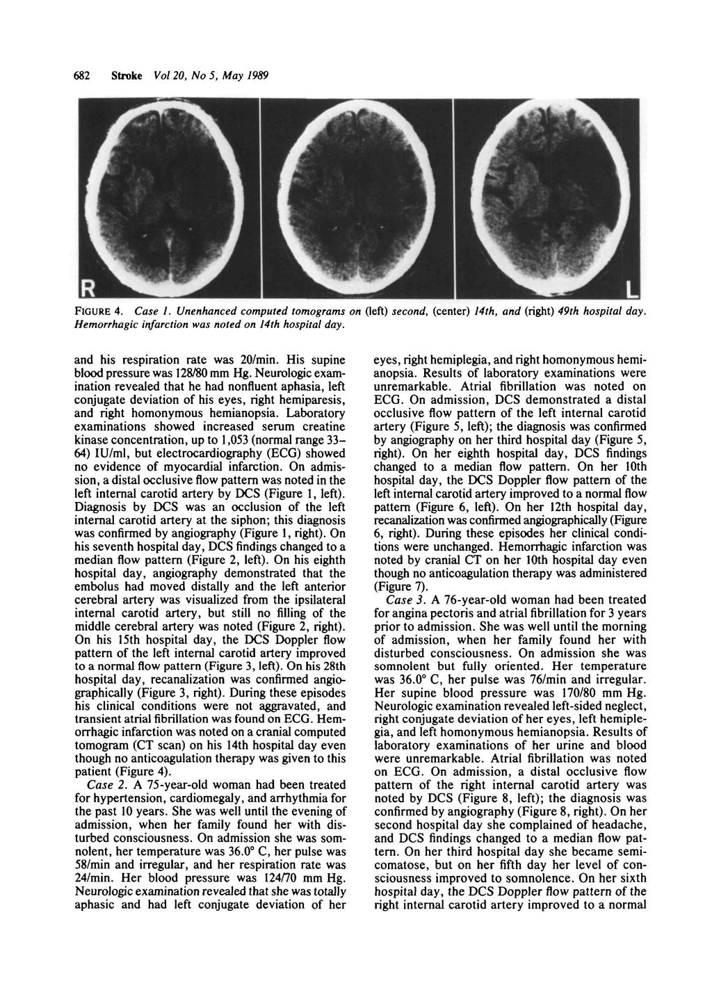 682 Stroke Vol 20, No 5, May 1989 FIGURE 4. Case 1. Unenhanced computed tomograms on Geft) second, (center) 14th, and (right) 49th hospital day. Hemorrhagic infarction was noted on 14th hospital day.