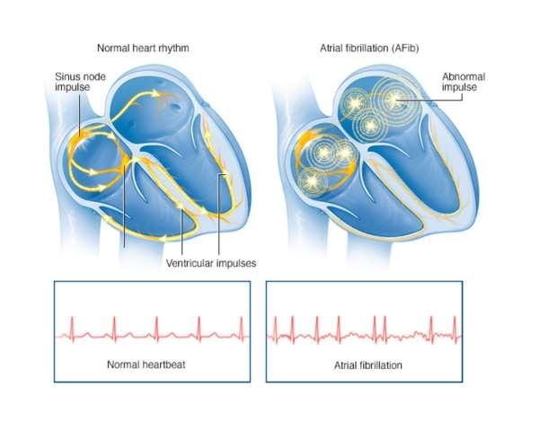 What causes Atrial Fibrillation? In people, atrial fibrillation can occur for no apparent reason (often in athletes or older people).