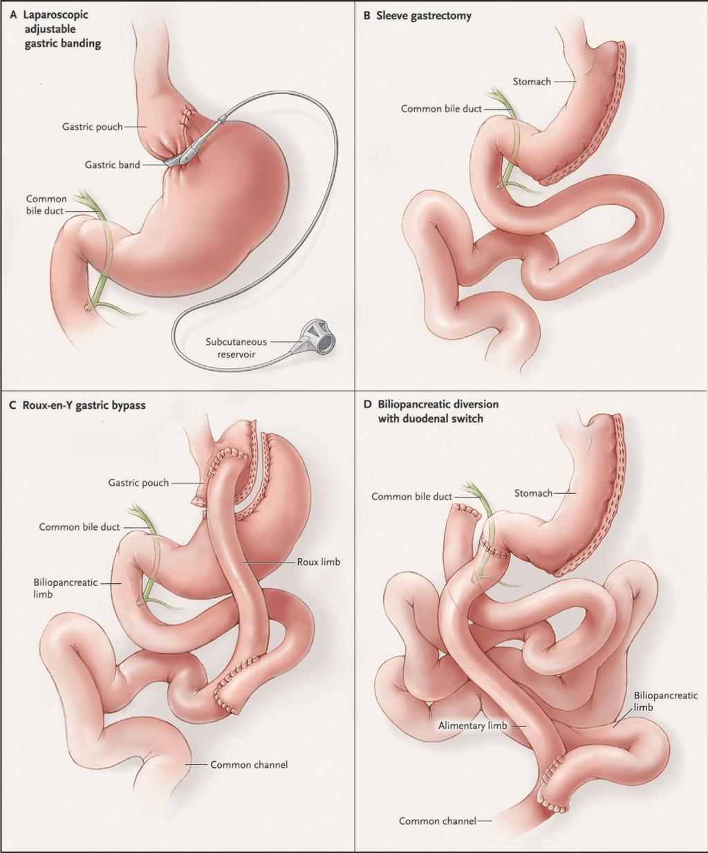 Fig. 1. procedures. Restrictive procedures include laparoscopic adjustable gastric banding (A) and sleeve gastrectomy (B).