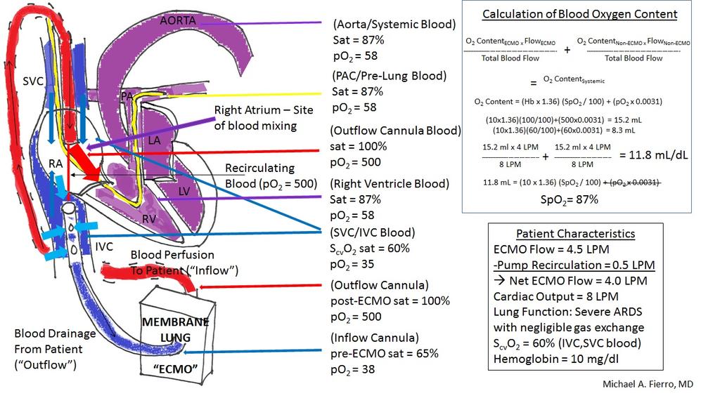 In summary, the main problems which occur in the operative management of the ECMO patient are: 1) Systemic Hypoxemia/Low systemic oxygen delivery which can be managed by increasing ECMO flows or