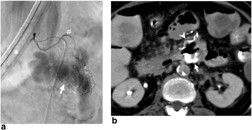 b: Selective arteriography of the first jejunum artery depicts the suspicious extravasation (*) of contrast medium which was difficult to differentiate from the duodenal wall.
